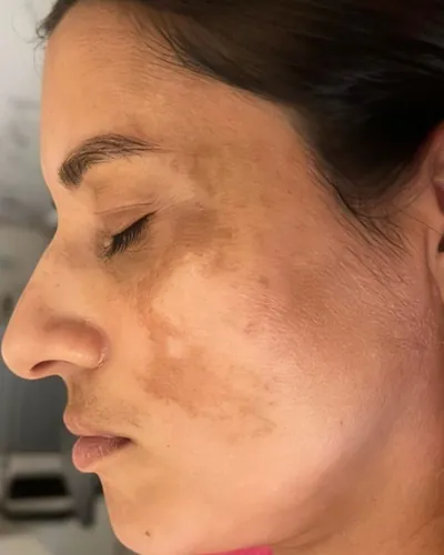 Rosto de cliente com manchas antes do uso