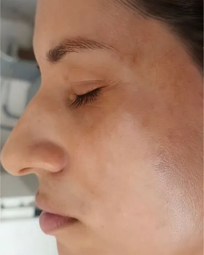Mesma cliente após 60 dias de uso do Melanix